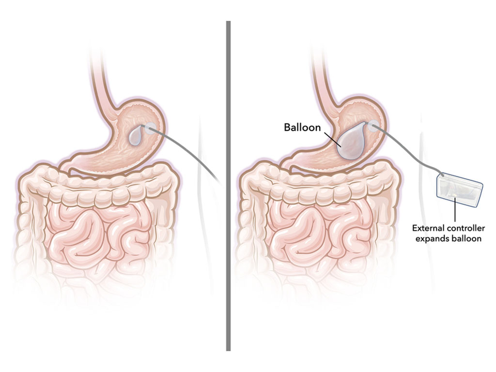 The new balloon is similar to a traditional gastric balloon. It is connected to an external controller that can be attached to the skin, and the system contains a pump that inflates and deflates the balloon when needed.